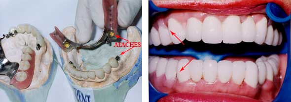 Prótesis dental con ataches