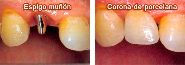 tratamiento de endodoncia