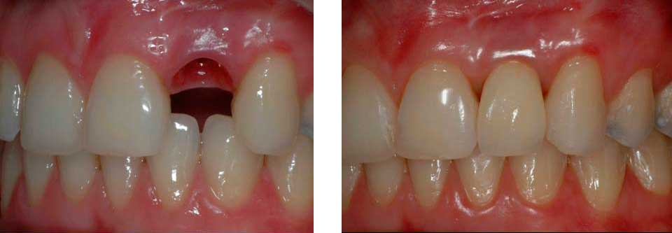 implante dental  oseointegrado