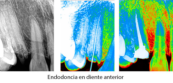 Endodoncia