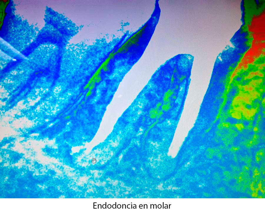 Caso endodoncia