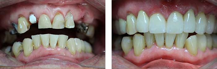 RehabilitaciÃ³n con coronas de porcelana